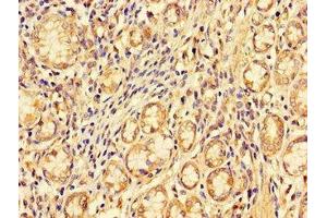 Immunohistochemistry of paraffin-embedded human gastric cancer using ABIN7151097 at dilution of 1:100 (PDZRN3 anticorps  (AA 133-404))