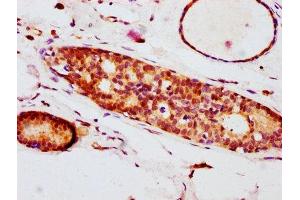 IHC image of ABIN7127691 diluted at 1:100 and staining in paraffin-embedded human breast cancer performed on a Leica BondTM system.