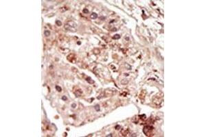 Formalin-fixed and paraffin-embedded human cancer tissue (hepatocarcinoma) reacted with the primary antibody, which was peroxidase-conjugated to the secondary antibody, followed by DAB staining. (STK31 anticorps  (C-Term))