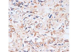 Immunohistochemistry of paraffin-embedded Human breast cancer using EIF4EBP1 Polyclonal Antibody at dilution of 1:100 (40x lens). (eIF4EBP1 anticorps)