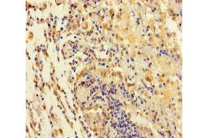 Immunohistochemistry of paraffin-embedded human lung cancer using ABIN7171552 at dilution of 1:100 (TAS2R42 anticorps  (AA 149-187))