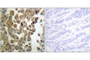 Immunohistochemistry analysis of paraffin-embedded human breast carcinoma, using PKC delta (Phospho-Thr505) Antibody. (PKC delta anticorps  (pThr507))