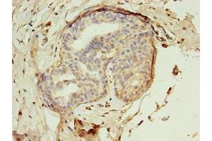 Immunohistochemistry of paraffin-embedded human breast cancer using ABIN7142288 at dilution of 1:100