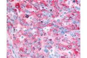 Human Ovarian Carcinoma (formalin-fixed, paraffin-embedded) stained with EGFR antibody ABIN213614 at 2. (EGFR anticorps)
