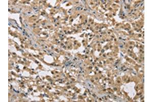 The image on the left is immunohistochemistry of paraffin-embedded Human thyroid cancer tissue using ABIN7129149(DACH2 Antibody) at dilution 1/40, on the right is treated with fusion protein. (DACH2 anticorps)