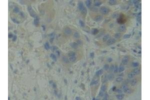 Detection of BMX in Human Breast cancer Tissue using Polyclonal Antibody to BMX Non Receptor Tyrosine Kinase (BMX)