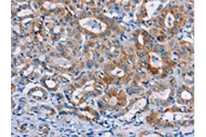 The image on the left is immunohistochemistry of paraffin-embedded Human thyroid cancer tissue using ABIN7128771(CASC3 Antibody) at dilution 1/20, on the right is treated with fusion protein. (CASC3 anticorps)