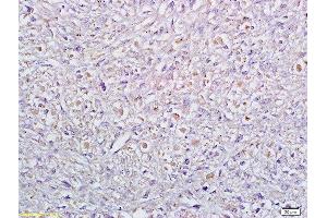 Formalin-fixed and paraffin embedded human cervical carcinoma labeled with Anti Sertad1 Polyclonal Antibody, Unconjugated  at 1:200 followed by conjugation to the secondary antibody and DAB staining (SERTAD1 anticorps  (AA 1-42))