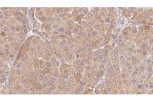 ABIN6277133 at 1/100 staining Human Melanoma tissue by IHC-P.