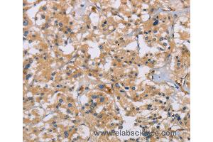 Immunohistochemistry of Human thyroid cancer using ACTN4 Polyclonal Antibody at dilution of 1:60 (alpha Actinin 4 anticorps)