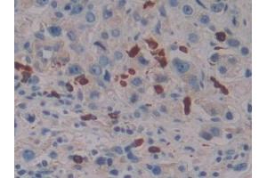 Detection of LAT2 in Human Prostate cancer Tissue using Polyclonal Antibody to Linker For Activation Of T-Cells Family, Member 2 (LAT2)