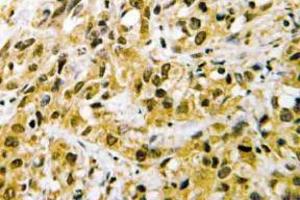 Immunohistochemistry (IHC) analyzes of NF-YC antibody in paraffin-embedded human liver carcinoma tissue. (NFYC anticorps)