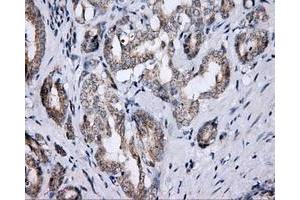 Immunohistochemical staining of paraffin-embedded Carcinoma of thyroid tissue using anti-LIPG mouse monoclonal antibody. (LIPG anticorps)