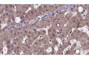 ABIN6277491 at 1/100 staining Human liver cancer tissue by IHC-P. (PAK1 anticorps  (Internal Region))