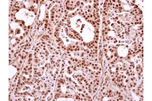 IHC-P Image Immunohistochemical analysis of paraffin-embedded NCIN87 xenograft, using Nuclear Matrix Protein p84 , antibody at 1:500 dilution. (THOC1 anticorps  (C-Term))