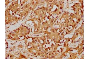 IHC image of ABIN7127533 diluted at 1:125 and staining in paraffin-embedded human liver cancer performed on a Leica BondTM system. (Recombinant GSTO1 anticorps)