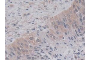 Detection of CYPA in Human Lung cancer Tissue using Monoclonal Antibody to Cyclophilin A (CYPA) (PPIA anticorps  (AA 2-165))