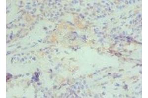 Immunohistochemistry of paraffin-embedded human breast cancer using ABIN7150954 at dilution of 1:100