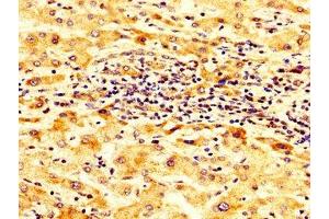 IHC image of ABIN7143973 diluted at 1:300 and staining in paraffin-embedded human liver cancer performed on a Leica BondTM system.
