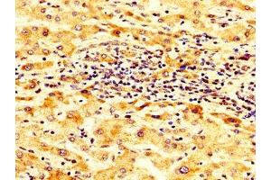 IHC image of ABIN7143973 diluted at 1:300 and staining in paraffin-embedded human liver cancer performed on a Leica BondTM system.