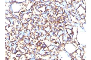 Formalin-fixed, paraffin-embedded human Angiosarcoma stained with Podocalyxin Mouse Monoclonal Antibody (3D3). (PODXL anticorps  (Extracellular Domain))