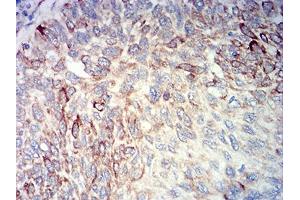 Immunohistochemical analysis of paraffin-embedded lung cancer tissues using BCL2L10 mouse mAb with DAB staining. (BCL2L10 anticorps  (AA 31-186))