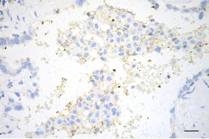 Immunohistochemistry was performed on paraffin-embedded human lung adenocarcinoma using CD274 antibody (ABIN7797962), 1:200). (Recombinant PD-L1 anticorps)