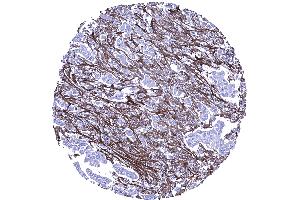 Abundant periostin positive stroma in an invasive lobular breast cancer