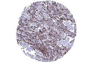 Abundant periostin positive stroma in an invasive lobular breast cancer (Periostin anticorps  (AA 193-326))
