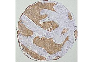 human head and neck squamous-cell carcinoma (HNSCC)(courtesy of J.