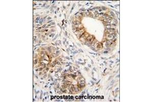 Formalin-fixed and paraffin-embedded human prostata carcinoma tissue reacted with PTGS1 antibody (C-term) (ABIN1882120 and ABIN2839444) , which was peroxidase-conjugated to the secondary antibody, followed by DAB staining. (PTGS1 anticorps  (C-Term))