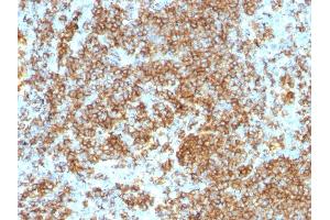 Formalin-fixed, paraffin-embedded human Lymphoma stained with CD45RB Monoclonal Antibody (PTPRC/1132).