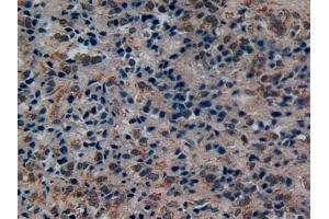 Detection of DISC1 in Human Prostate cancer Tissue using Polyclonal Antibody to Disrupted In Schizophrenia 1 (DISC1) (DISC1 anticorps  (AA 102-261))