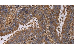 Immunohistochemistry of paraffin-embedded Human colon cancer using FADS1 Polyclonal Antibody at dilution of 1:60 (FADS1 anticorps)