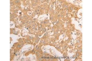 Immunohistochemistry of Human lung cancer using NAP1L1 Polyclonal Antibody at dilution of 1:50