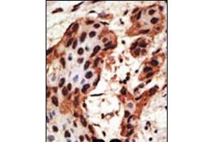 Formalin-fixed and paraffin-embedded human cancer tissue reacted with the primary antibody, which was peroxidase-conjugated to the secondary antibody, followed by AEC staining.