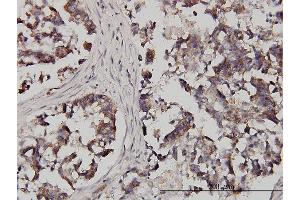 Immunoperoxidase of monoclonal antibody to FXR1 on formalin-fixed paraffin-embedded human colon adenocarcinoma.