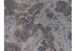 Detection of SCFR in Human Breast cancer Tissue using Polyclonal Antibody to Stem Cell Factor Receptor (SCFR)