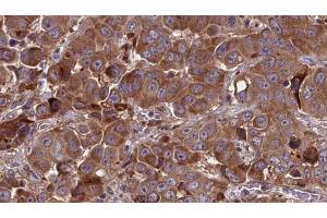 ABIN6273837 at 1/100 staining Human liver cancer tissue by IHC-P. (Serotonin Receptor 3A anticorps  (Internal Region))