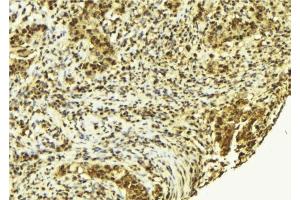 ABIN6278092 at 1/100 staining Human breast cancer tissue by IHC-P. (alpha Actinin 4 anticorps  (C-Term))