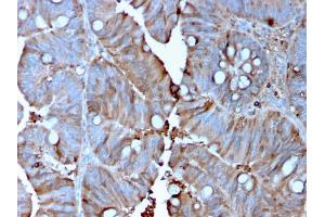 Formalin-fixed, paraffin-embedded human Colon Carcinoma stained with MerTK Mouse Monoclonal Antibody (MERTK/3015). (MERTK anticorps  (AA 55-148))