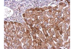 IHC-P Image PLGF antibody detects PGF protein at cytosol on human hepatoma by immunohistochemical analysis. (PLGF anticorps)