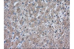 Immunohistochemical staining of paraffin-embedded Carcinoma of Human prostate tissue using anti-ACAT2 mouse monoclonal antibody. (ACAT2 anticorps)