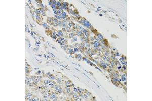 Immunohistochemistry of paraffin-embedded human liver cancer using SH2B1 Antibody (ABIN5973245) at dilution of 1/100 (40x lens). (SH2B1 anticorps)
