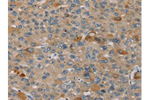 The image on the left is immunohistochemistry of paraffin-embedded Human liver cancer tissue using ABIN7130584(PEF1 Antibody) at dilution 1/20, on the right is treated with fusion protein. (PEF1 anticorps)