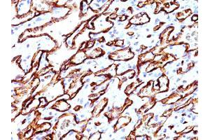 Immunohistochemical staining of human angiosarcoma (20X) with PODXL monoclonal antibody, clone 3D3  at 1:500 dilution. (PODXL anticorps  (Extracellular Domain))