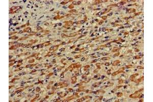 Immunohistochemistry of paraffin-embedded human liver cancer using ABIN7155043 at dilution of 1:100 (c-MET anticorps  (AA 83-209))