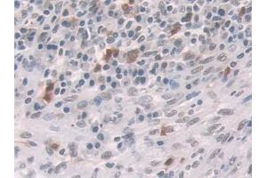 IHC-P analysis of Human Colorectal cancer Tissue, with DAB staining. (Glucocorticoid Receptor anticorps  (AA 532-730))