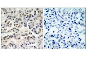 Immunohistochemical analysis of paraffin-embedded human lung carcinoma tissue using p27Kip1 (Ab-10) antibody (E021150). (CDKN1B anticorps)