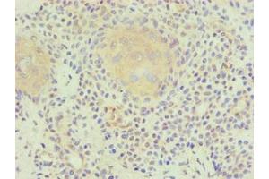 Immunohistochemical of paraffin-embedded human breast cancer using ABIN7176818 at dilution of 1:200.